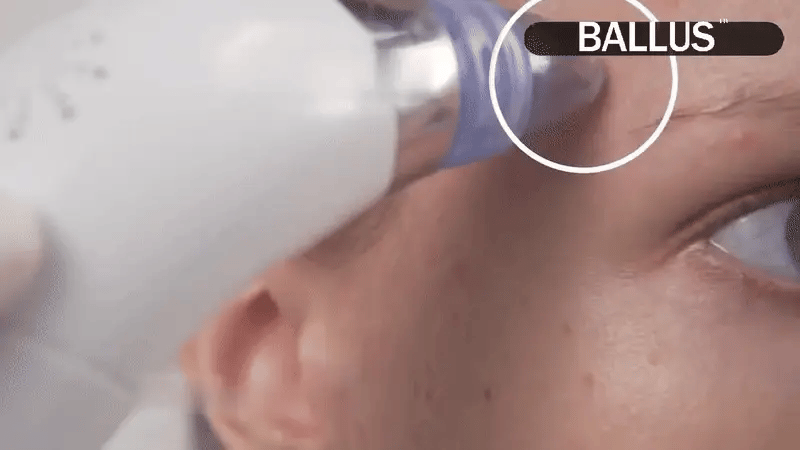 UltraSuction™ Facial Pore Cleaner – For Clear & Smooth Skin